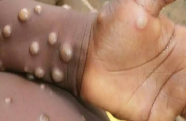 More than 200 cases of monkeypox worldwide