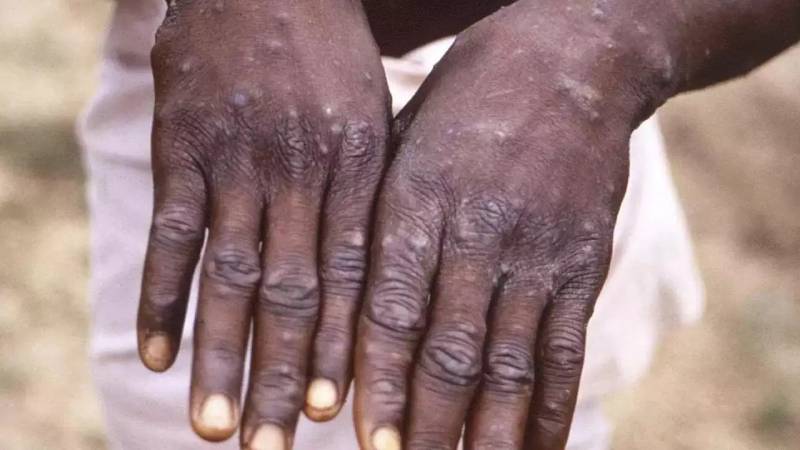 Nigeria confirms 21 cases of monkeypox since January