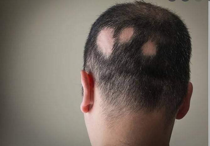 US approves first pill for treatment of alopecia