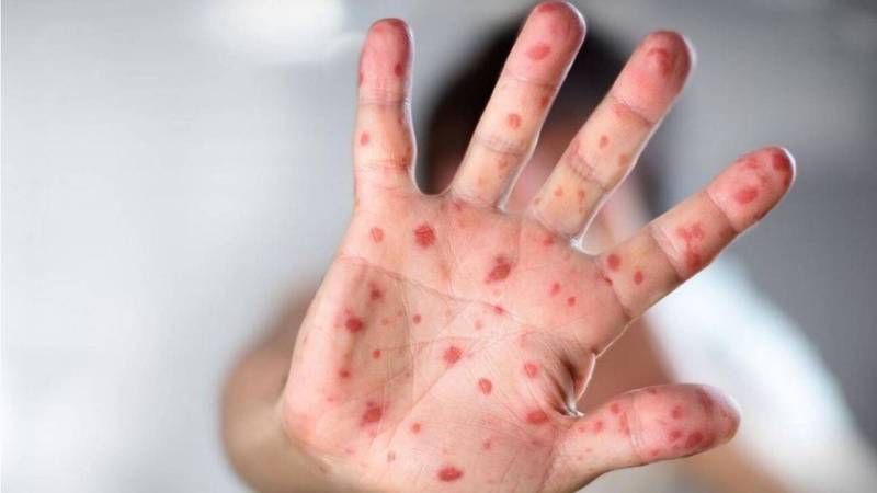 WHO calls for 'urgent' action in Europe over monkeypox