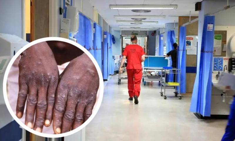 World monkeypox outbreak tops 50,000 cases