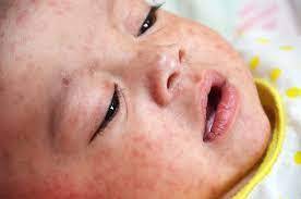 Three kids die of measles in Loralai 