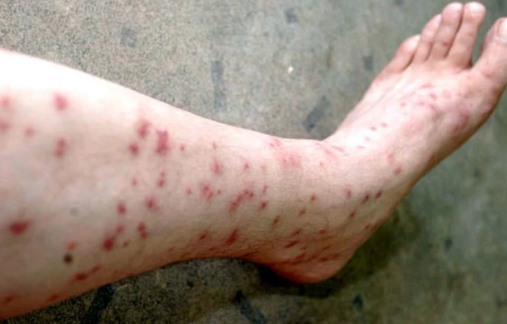 46 cases reported as Jhelum people falling victim to sandfly attacks