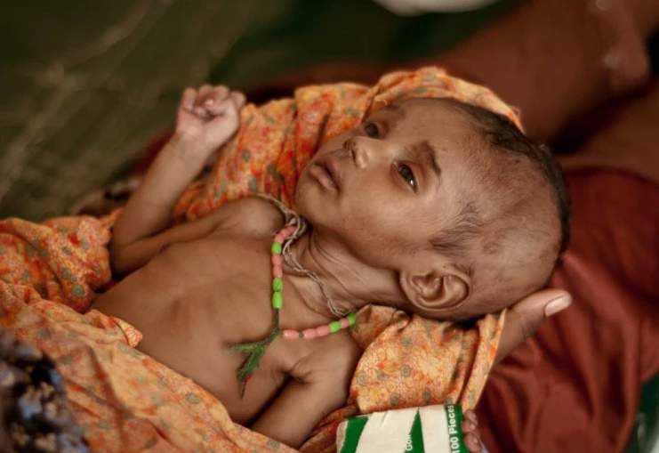 Seven more kids die due to malnutrition, diseases in Tharparkar