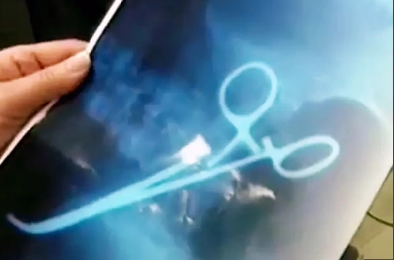 Scissors found in Karachi woman’s tummy during CT scan