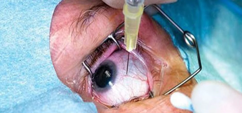 Contaminated drug causes vision loss for dozens of Pakistan diabetics