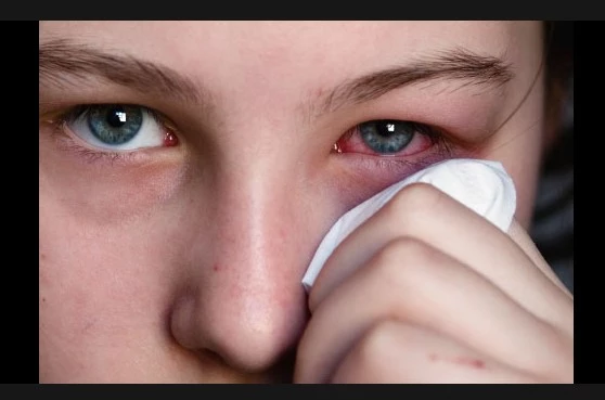 Thousands infected as pink-eye outbreak spreads across Punjab
