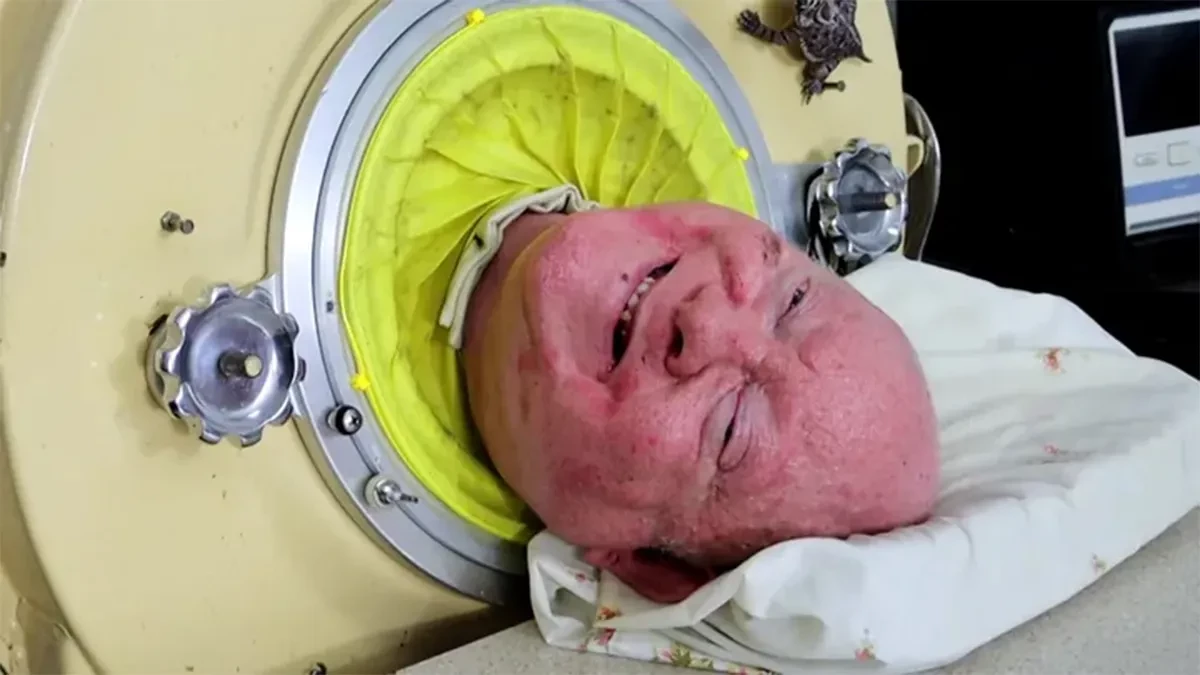'Man in iron lung' dead at 78: family