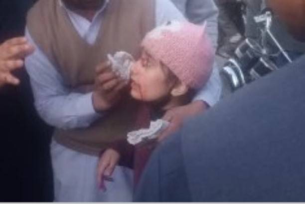 Kite string injures face of 4-year-old girl in Rawalpindi