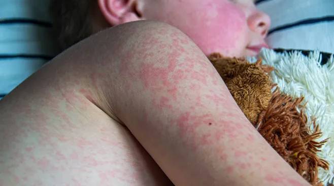 Texas child dies in measles outbreak, first US fatality in years