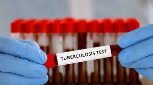 UK drawing up new action plan to tackle rising TB