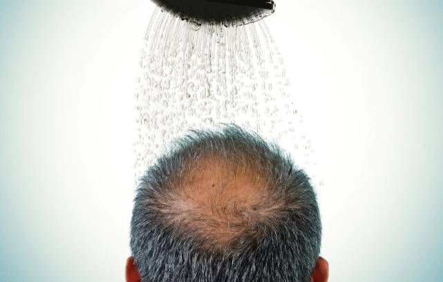 Balding may become a thing of past with THIS new scientific discovery