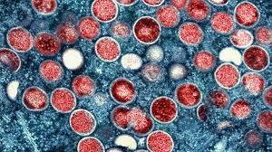 UK health authorities probe unexplained mpox infection