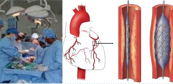 PA probe reveals PIC found to be using expired stents in heart patients 