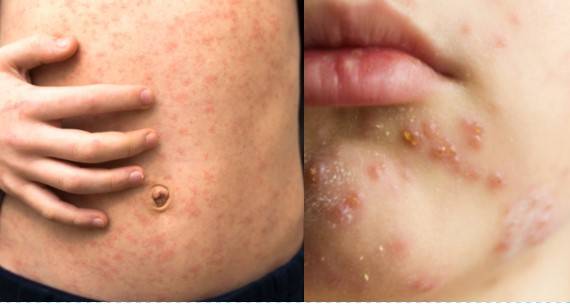 Measles outbreak claims two young lives in Jacobabad