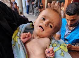 Gaza hospital says 21 children dead from malnutrition and starvation