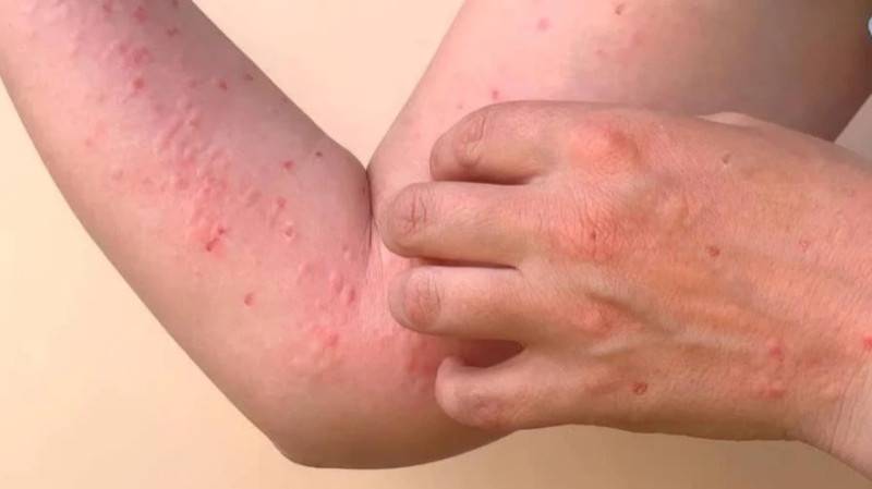 WHO sounds alarm on risk of chikungunya epidemic