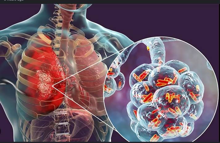 Legionnaires' disease outbreak kills 5, hospitalizes 14 in New York
