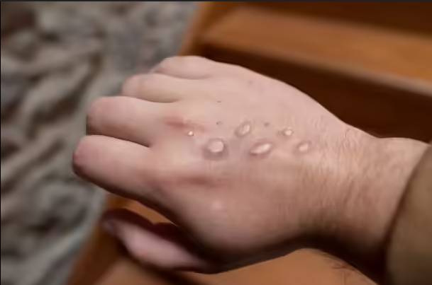 Country’s first monkey-pox case reported in Islamabad 