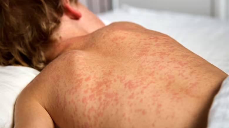 Canada measles cases pass 4,500, highest count in Americas
