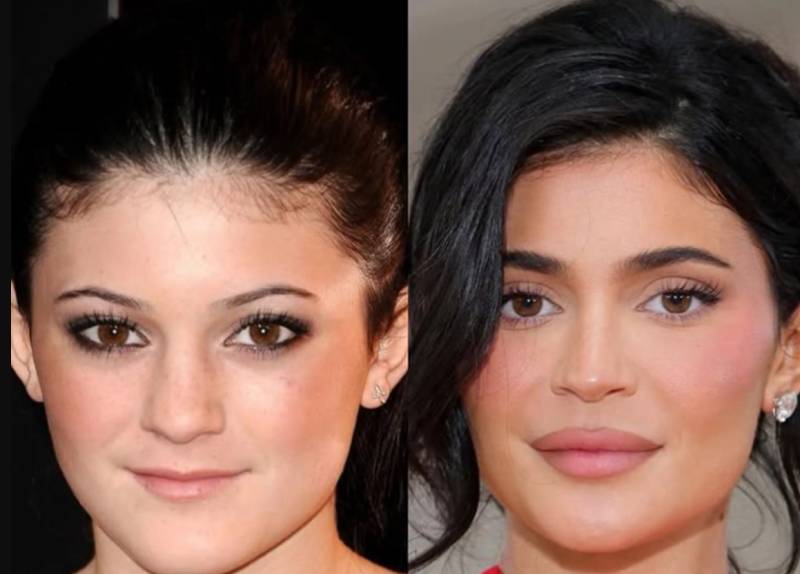 Amanda Bynes debuts new look after Kylie Jenner-promoted lip filler procedure