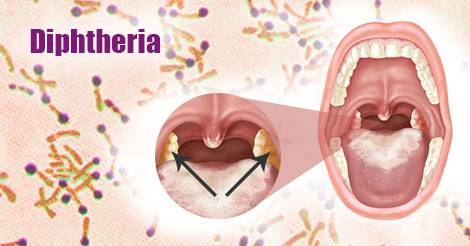 Diphtheria outbreak worsens in Mardan as another child dies