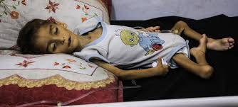 UN says over 10,000 children with acute malnutrition in Gaza City