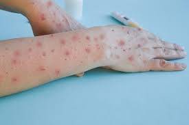 Lahore reports first case of monkeypox