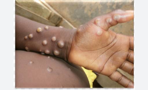 Second mpox case reported in Sindh