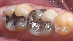 Countries call for mercury dental fillings ban by 2030