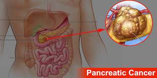 AI system surpasses radiologists in spotting pancreatic cancer on standard CT scans