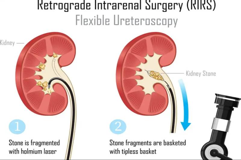 First-ever non-touch RIRS Technique for kidney stones performed in Lahore