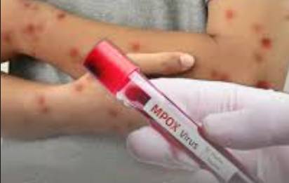 Three more cases of monkeypox reported from Lahore