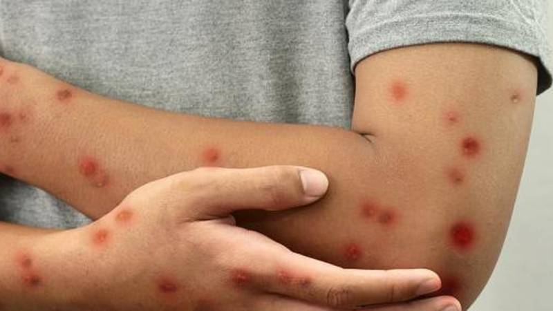 PMA Lahore raises alarm over rising Monkeypox cases in city