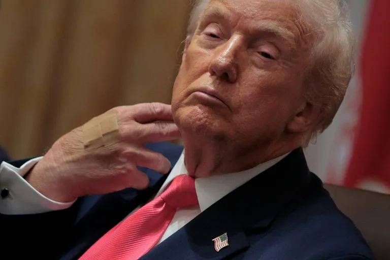 Trump blames bruised hand on aspirin, denies falling asleep