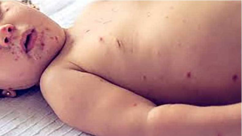 Three children die of measle outbreak in Khairpur 