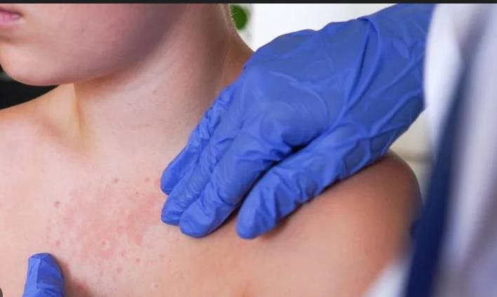 US measles epidemic grows with South Carolina outbreak