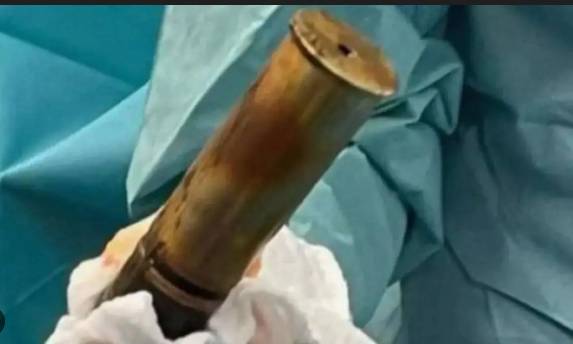 French hospital treats man with shell up his rectum
