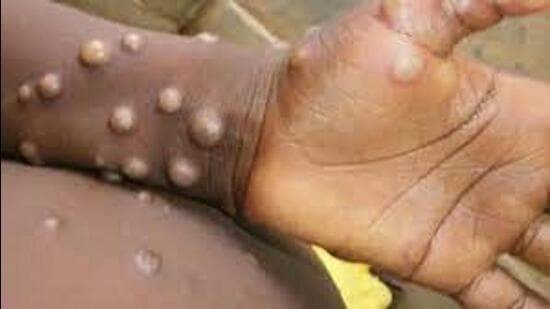 Monkeypox case confirmed in South Punjab