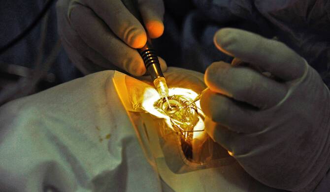 94 million need cataract surgery, but access lacking: WHO