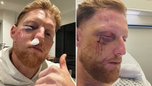 England captain Stokes has surgery after being hit in face by ball