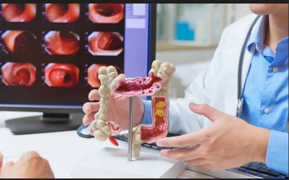 Why are more under-50s getting colorectal cancer?