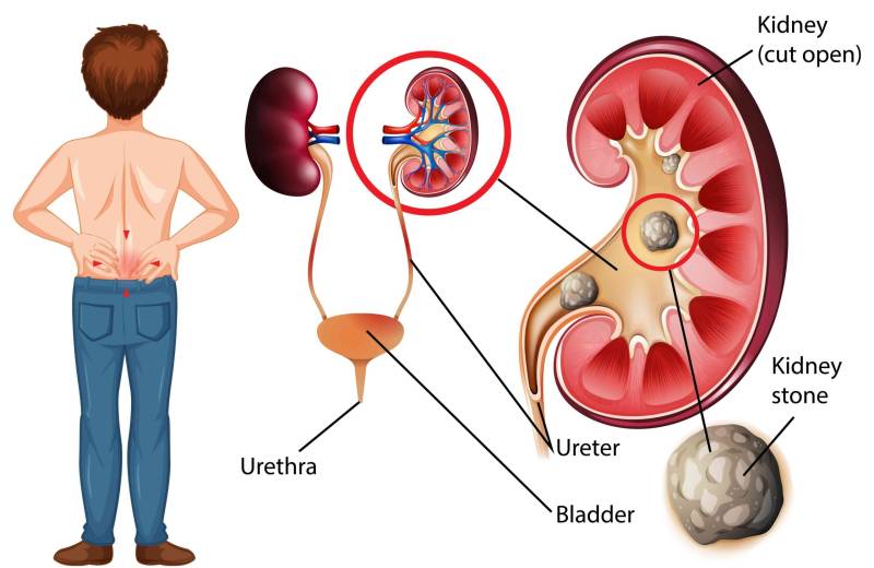 Kidney stones: Staying hydrated while fasting is key to prevent painful episodes