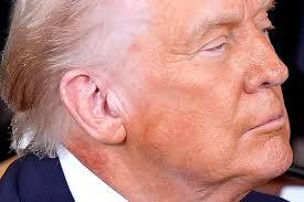 Trump appears with red rash on neck