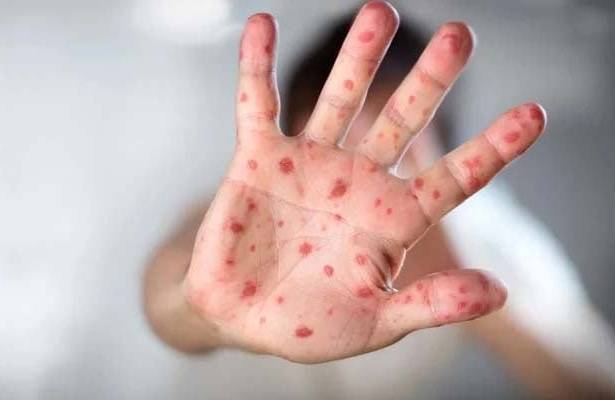 Seven children die of measles outbreak in Kabirwala