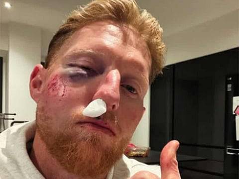England skipper Stokes sidelined after gruesome facial injury