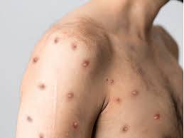 Nine dead as Monkeypox cases rise in Sindh