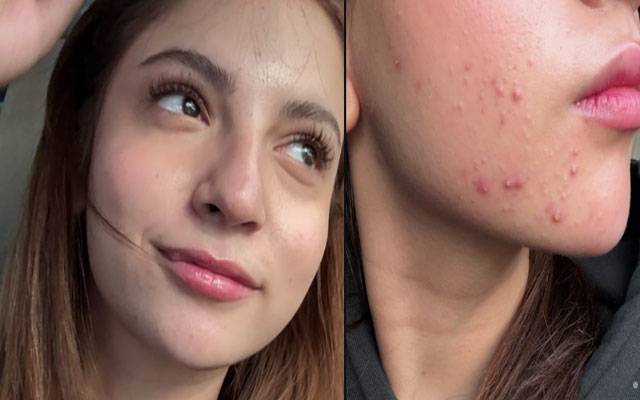 Dananeer Mobeen shatters ‘perfect skin’ myth with brutally honest post