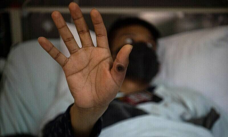 Another case of monkeypox reported in Karachi