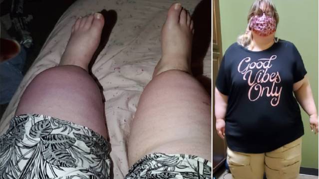 Women reveal battle with little-known chronic leg fat condition